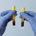 hands-with-gloves-holding-vials-prp